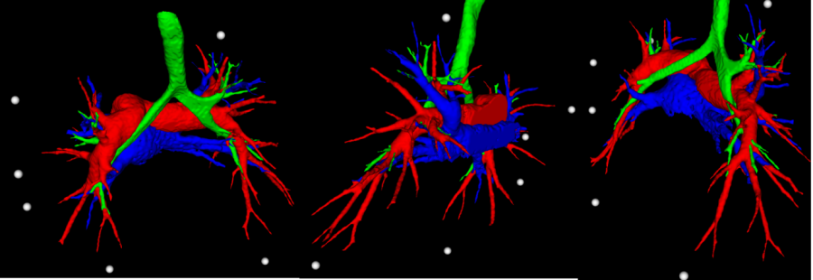 基于CT的胸外科手术三维成像显示系统